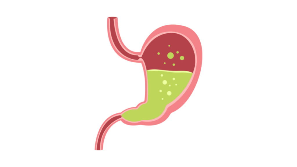Cara Mengatasi Asam Lambung